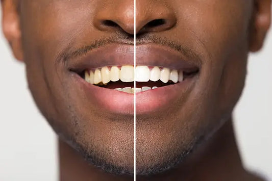 Why Are My Teeth Yellow When I Brush Everyday?